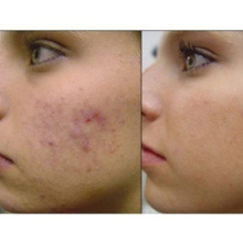 Equipamento de beleza mais quente usado para remoção de melasma, ceratose actínica